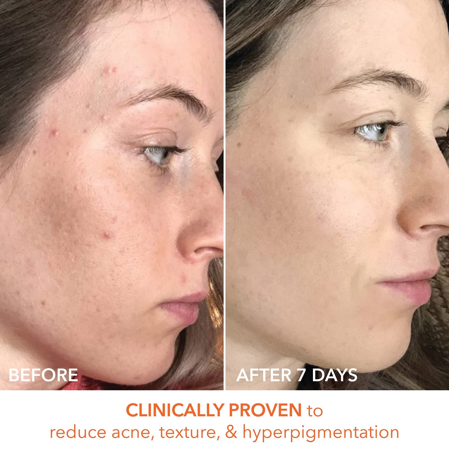 Dr. Dennis Gross Alpha Beta Universal Daily Peel 60 Treatments